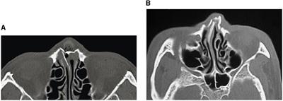 A review on artificial intelligence for the diagnosis of fractures in facial trauma imaging